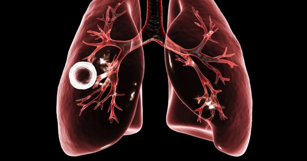tuberculose