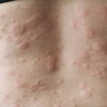 Urticaria china cronica - 1