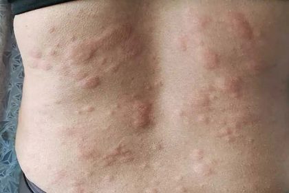 Urticaria china cronica - 1