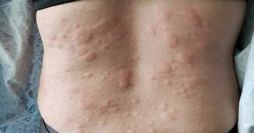 Urticaria china cronica - 1